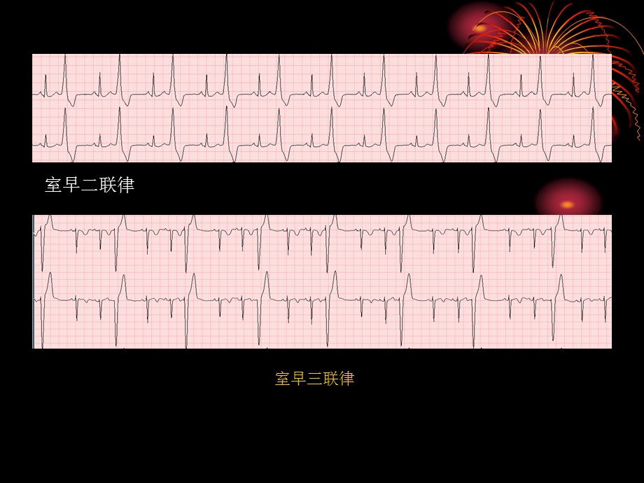 《期前收缩》ppt课件.ppt_第2页