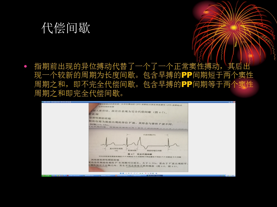 《期前收缩》ppt课件.ppt_第3页