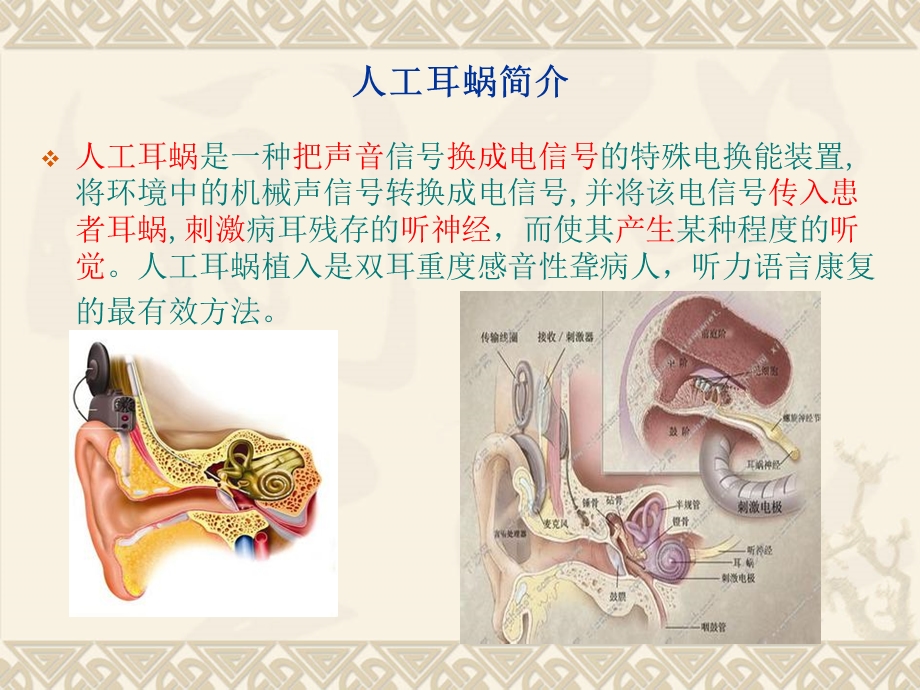 儿童人工耳蜗植入术的简介及麻醉要点-赵献亮.ppt_第2页