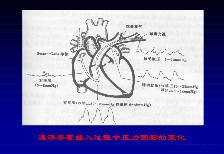 《心脏介入治疗》ppt课件.ppt_第2页