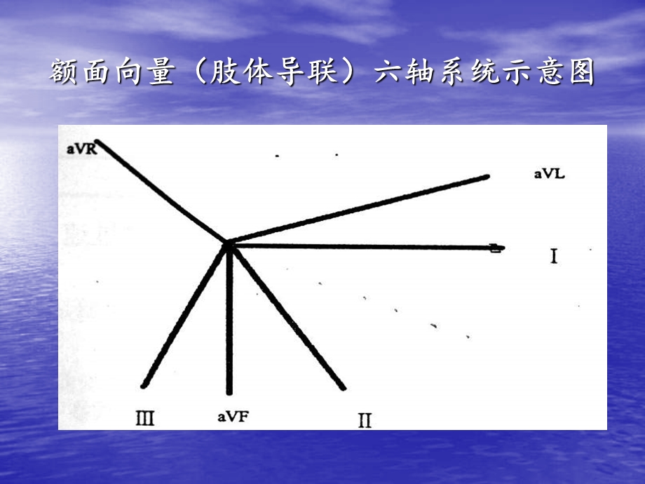 不同部位起源的室性早搏在aVR导联QRS波特征.ppt_第3页