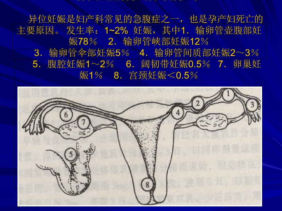 《异位妊娠》课件.ppt_第3页