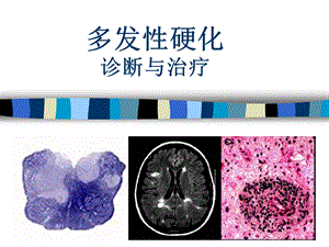 多发性硬化的诊断与治疗.ppt