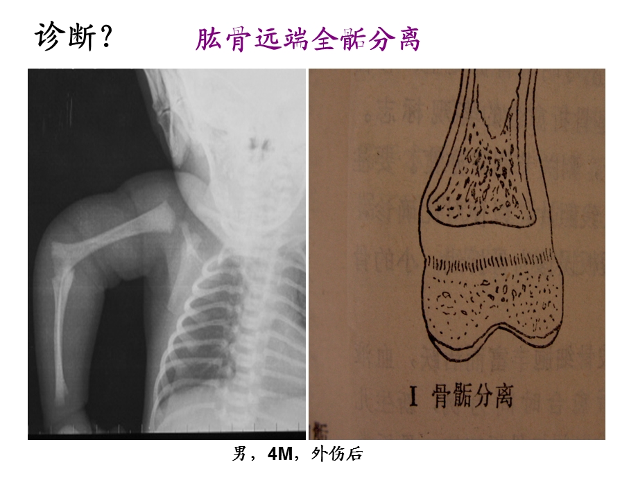 儿童骨骺损伤影像诊断(急).ppt_第2页