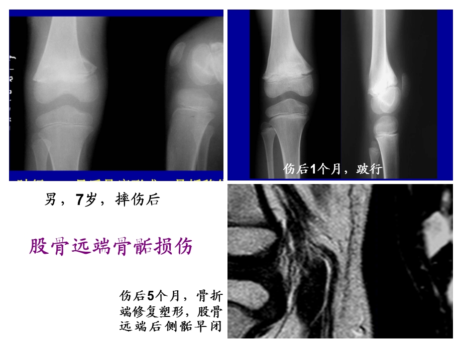 儿童骨骺损伤影像诊断(急).ppt_第3页