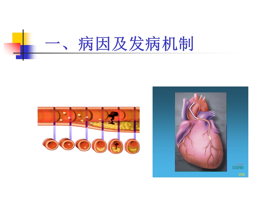 动脉粥样硬化和冠状动脉动脉粥样硬化性心脏病.ppt_第3页