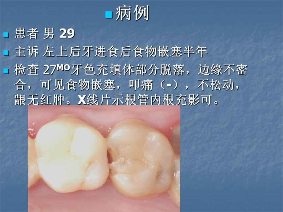 分段成型片的临床应用北大口腔.ppt_第2页