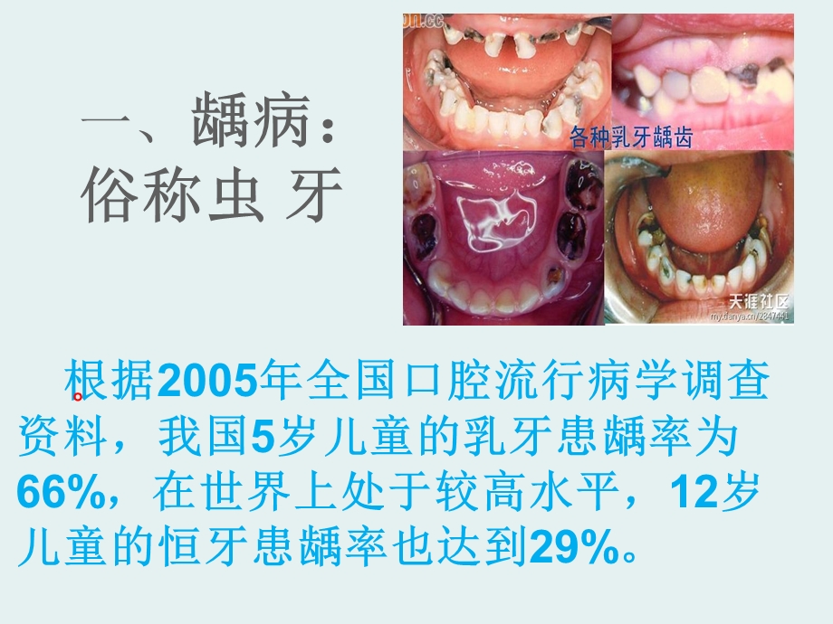 儿童牙病的预防.ppt_第3页