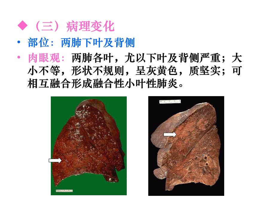 大叶性肺炎、小叶性肺炎、间质性肺炎(下部分).ppt_第3页