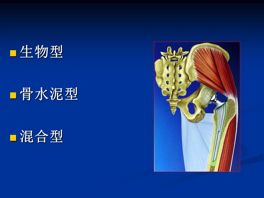 初次全髋关节置换实用技术.ppt_第3页