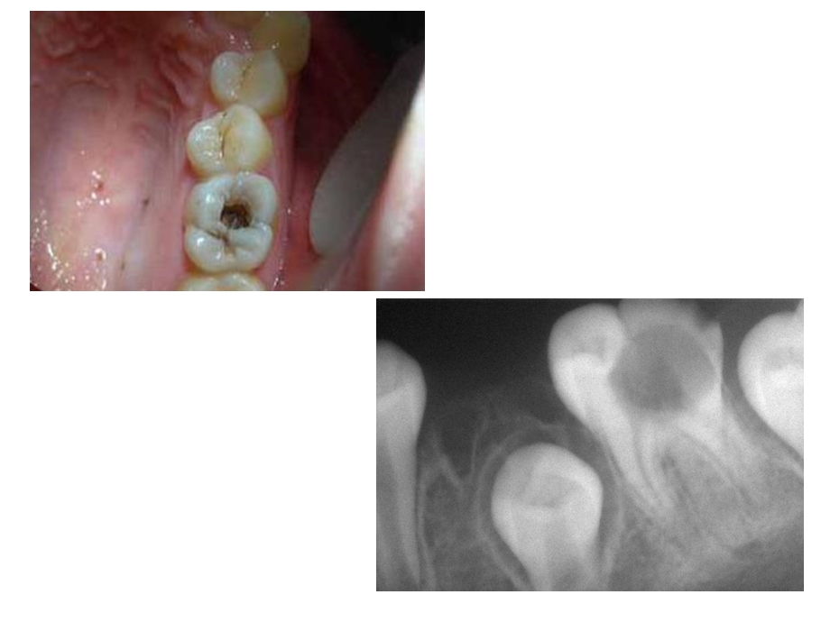 儿童龋病的治疗和预防.ppt_第2页