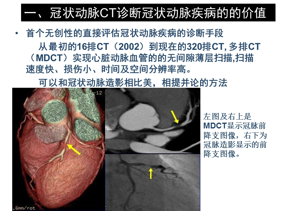 冠脉CT在心血管内科疾病中的应用价值.ppt_第3页