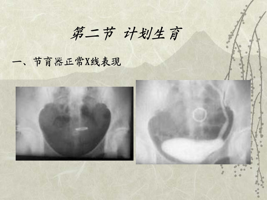 妇科疾病影像诊断.ppt_第3页