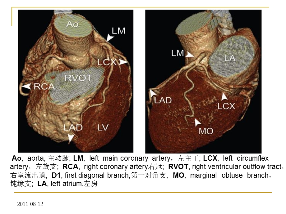 冠状动脉cta图像判读.ppt_第2页