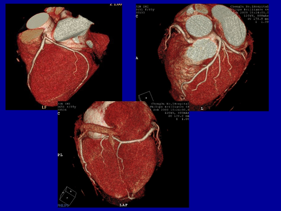 冠状动脉CTA成像.ppt_第3页