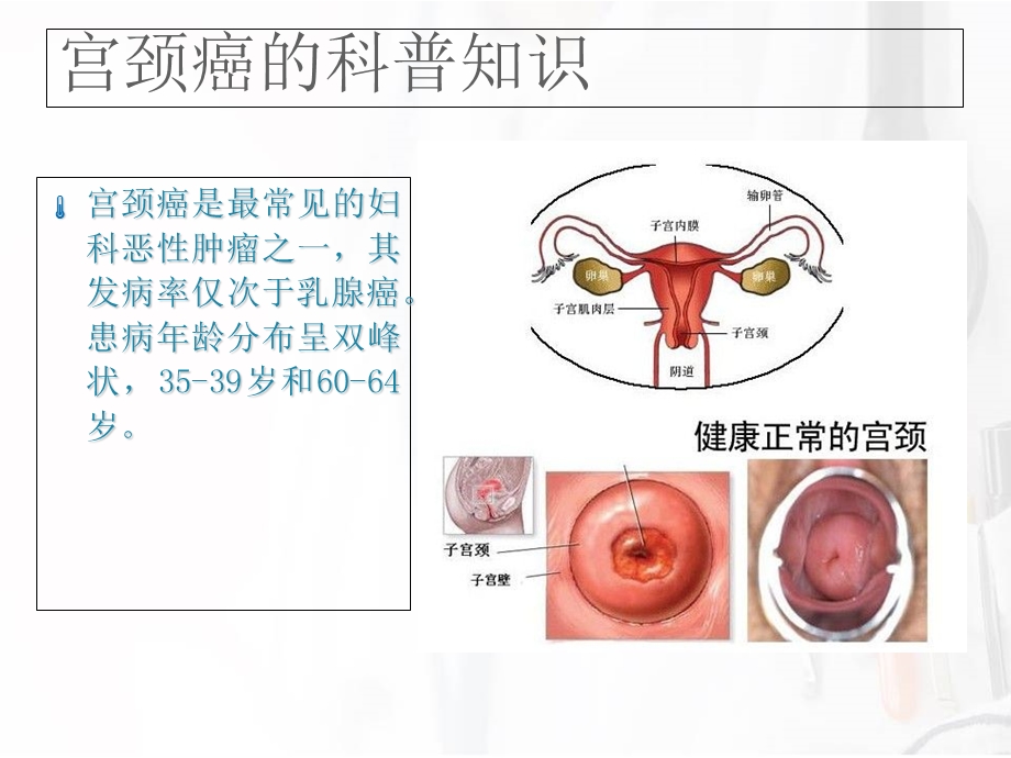 宫颈癌广泛性子宫切除+盆腔淋巴结清扫手术配合.ppt_第2页