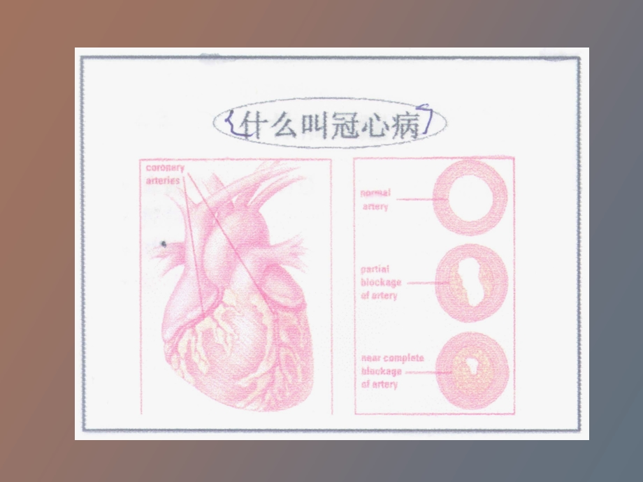 冠心病预防、治疗、康复.ppt_第2页