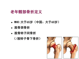 最新：[临床医学]裴福兴老年髋部骨折围手术期的评估与处理文档资料.ppt