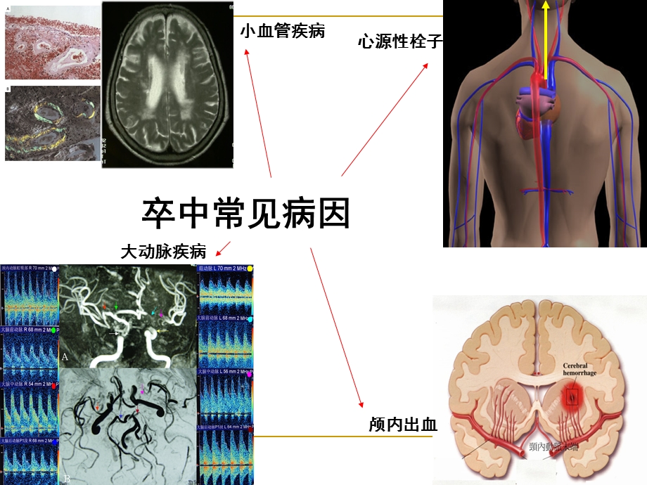 房颤患者脑卒中的防治姚哓喜1ppt课件文档资料.ppt_第3页