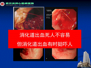 心血管疾病中消化道出血的防治ppt课件文档资料.ppt