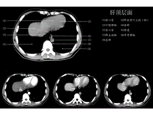 上腹部CT各个层面课件PPT文档.ppt