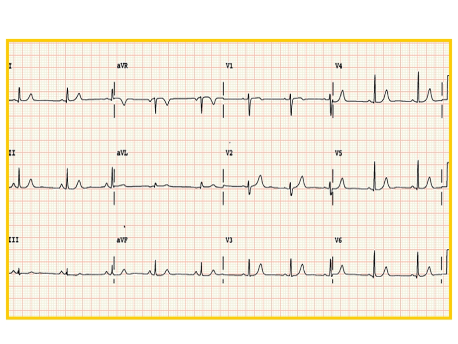 正常心电图文档资料.ppt_第1页
