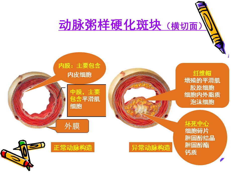 最新中医治疗动脉粥样硬化是锦上添花还是雪中送炭PPT文档.ppt_第3页