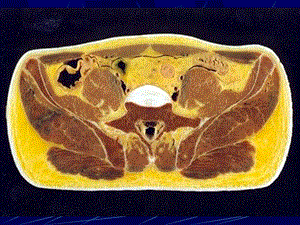 男性盆部与会阴断层解剖文档资料.ppt