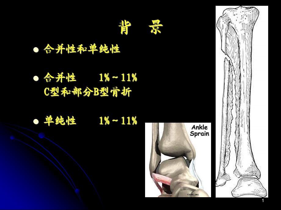 两种材料螺钉固定下胫腓联合损伤的前瞻性随机对照研究...PPT文档.ppt_第1页