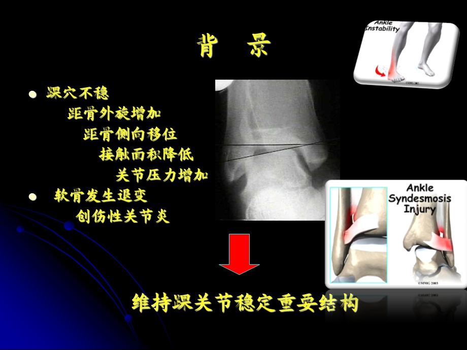 两种材料螺钉固定下胫腓联合损伤的前瞻性随机对照研究...PPT文档.ppt_第2页