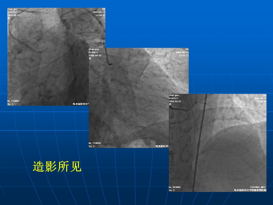 最新：cto病变：全逆行技术临床应用李学奇文档资料.ppt_第2页