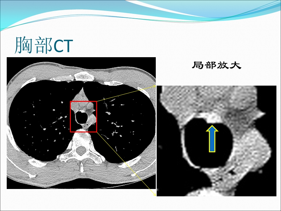 病例报告气管支气管骨化病文档资料.ppt_第2页