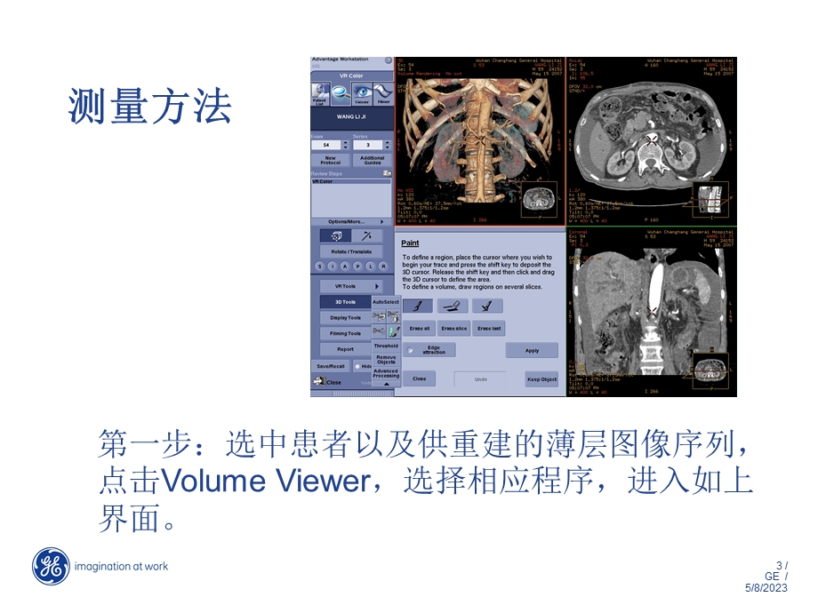 全肝体积快速测量文档资料.ppt_第3页