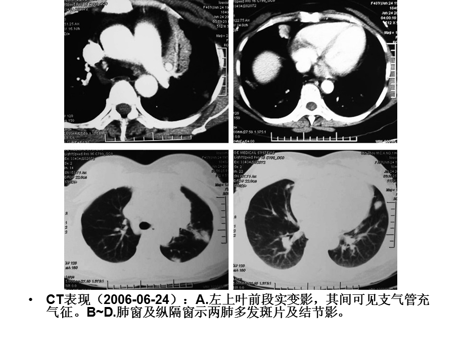 呼吸科病例讨论文档资料.ppt_第2页