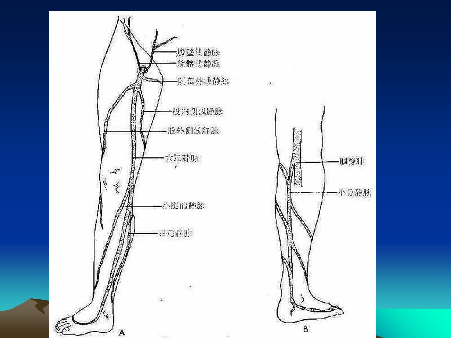 下肢静脉曲张诊断与治疗精选文档.ppt_第3页