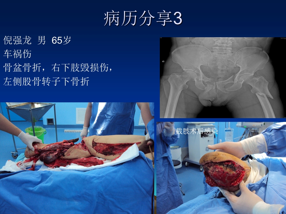 培训资料vsd在创伤中的应用文档资料.ppt_第3页