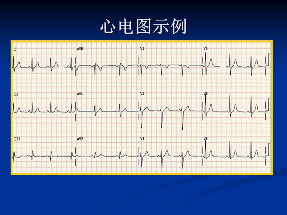 心电图产生原理和正常心电图文档资料.ppt_第3页