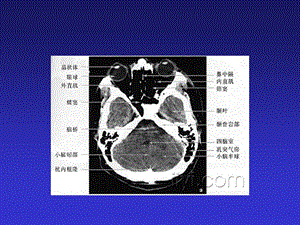最新正常头颅CTPPT课件PPT文档.ppt