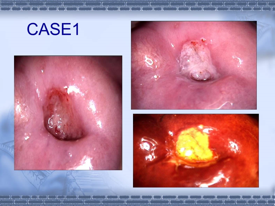 宫颈病例分享.5.23ppt课件文档资料.ppt_第2页