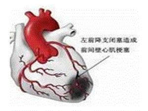 最新：1 主动脉夹层图片文档资料.ppt