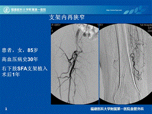 福建医科大学附属第一医院血管外科文档资料.ppt