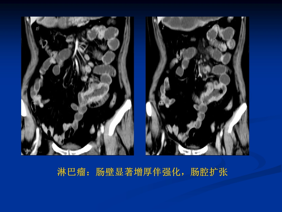 影像学五年制胃肠道2文档资料.ppt_第2页