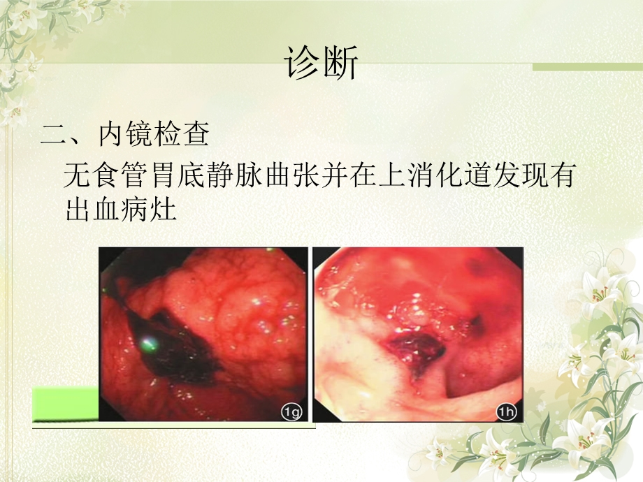 急性非静脉性上消化道出血诊治ppt课件文档资料.ppt_第3页