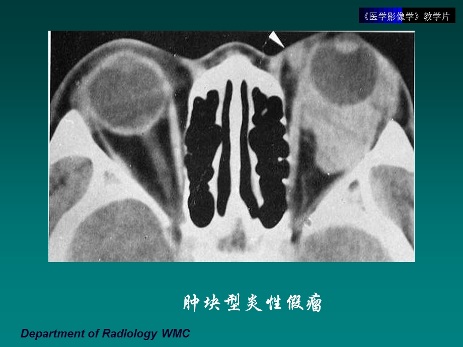 影像学 五官头颈部文档资料.ppt_第3页