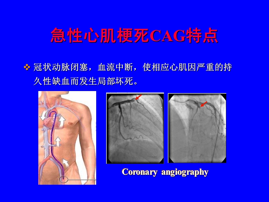 急性心肌梗死的心电图讲课文档资料.ppt_第3页