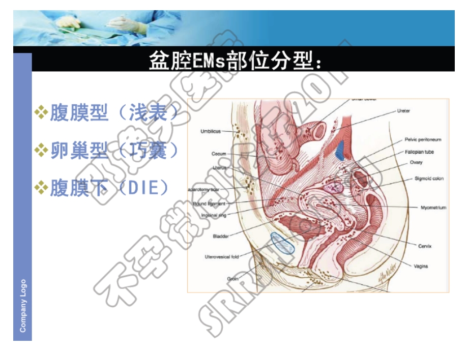 提纲EMs与不孕策略1.ppt_第3页