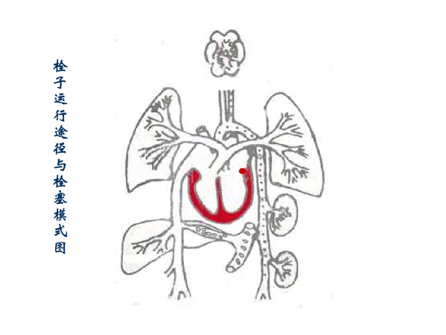 第四章栓塞梗死2.ppt_第3页