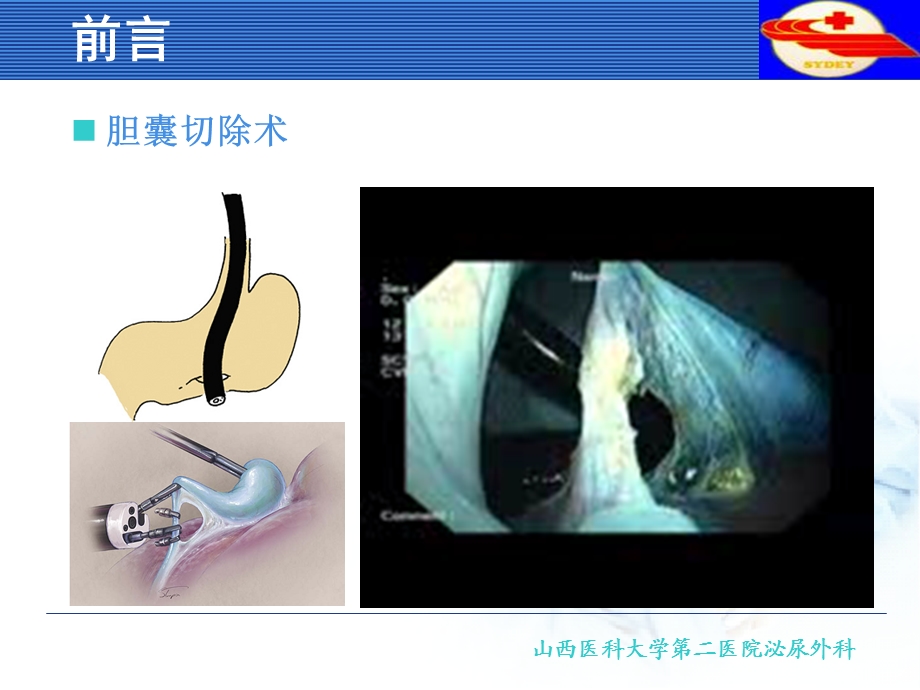 NOTES经自然腔道内镜手术.ppt_第2页