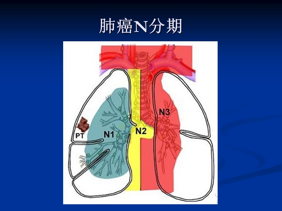 肺癌淋巴结分组ppt课件.ppt_第3页