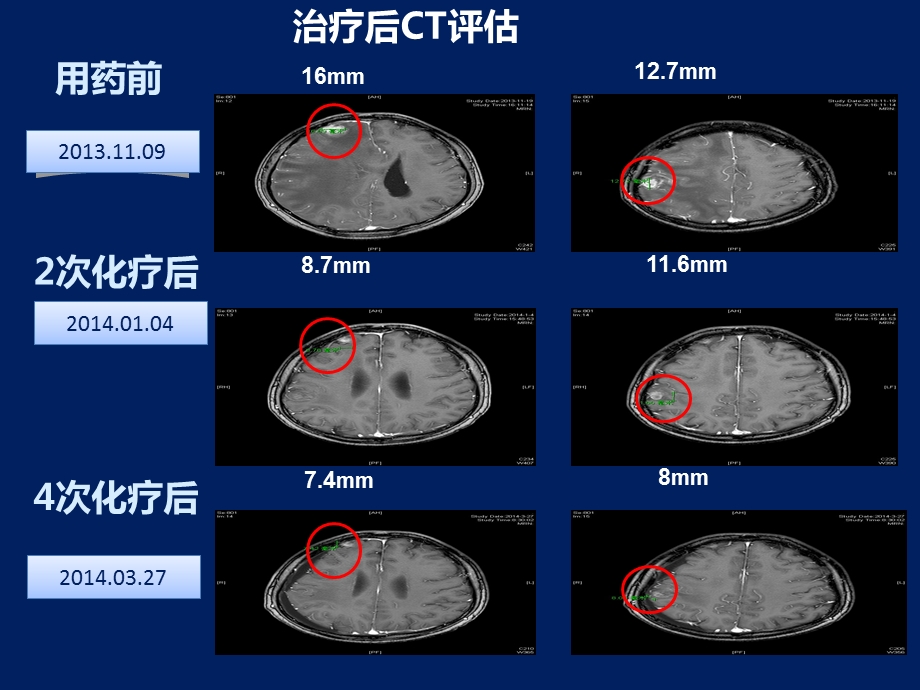 安维汀肺癌脑转移患者分子靶向治疗的疗效和安全性ppt课件.ppt_第3页